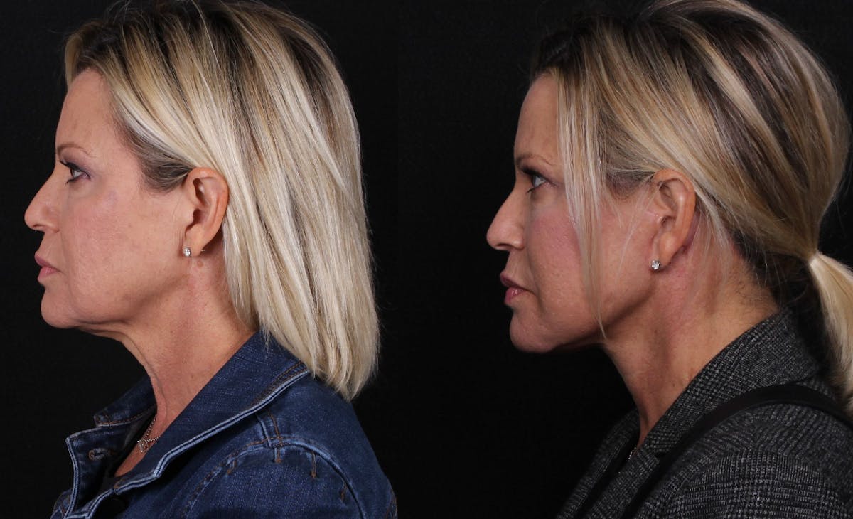 Face & Neck Lift Before & After Gallery - Patient 406808 - Image 5