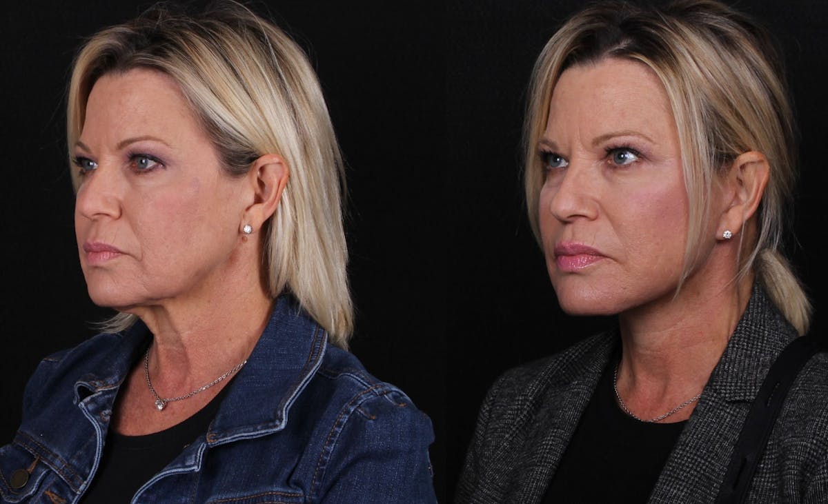Face & Neck Lift Before & After Gallery - Patient 406808 - Image 4