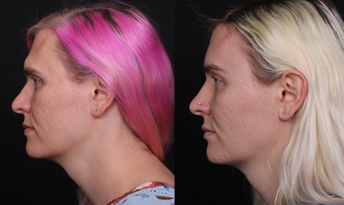 Facial Feminization Surgery (FFS) Before & After Gallery - Patient 296077 - Image 5