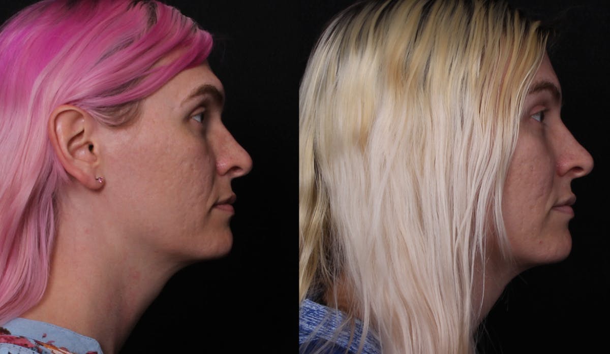 Facial Feminization Surgery (FFS) Before & After Gallery - Patient 296077 - Image 3