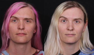 Facial Feminization Surgery (FFS) Before & After Gallery - Patient 296077 - Image 1