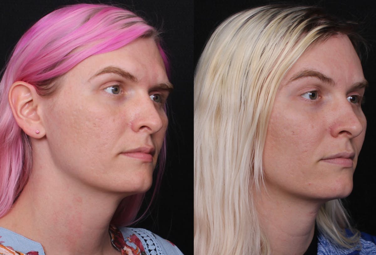 Facial Feminization Surgery (FFS) Before & After Gallery - Patient 296077 - Image 2