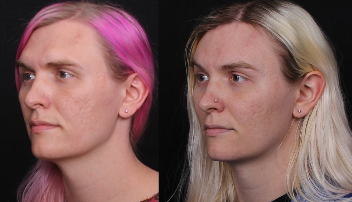 Facial Feminization Surgery (FFS) Before & After Gallery - Patient 296077 - Image 4