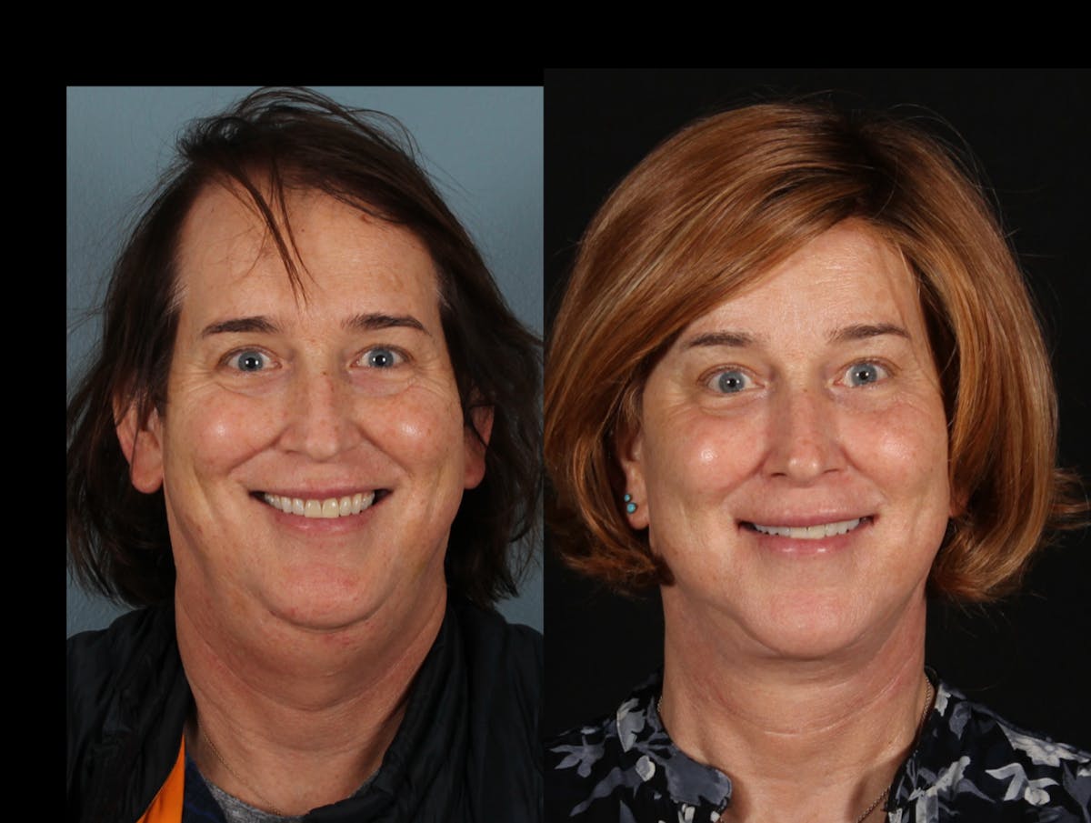 Facial Feminization Surgery (FFS) Before & After Gallery - Patient 298135 - Image 1
