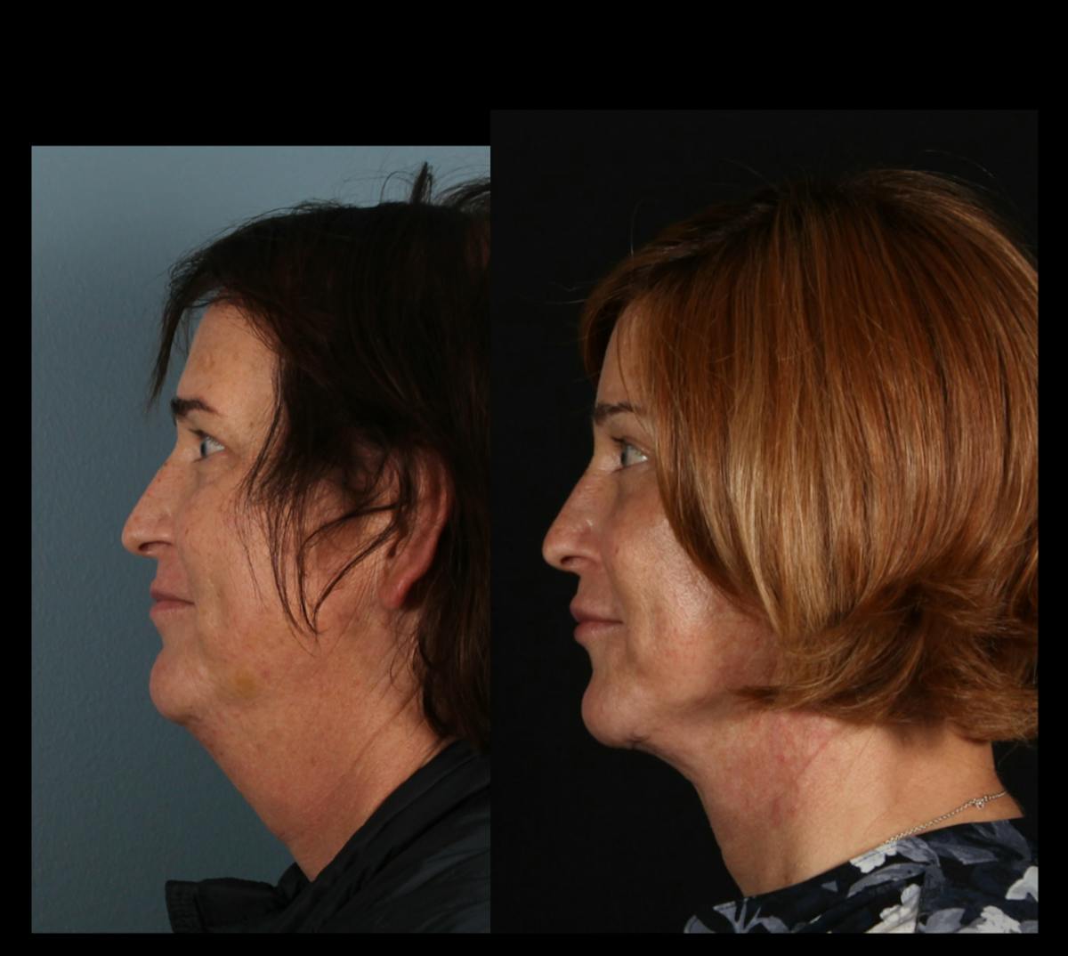 Facial Feminization Surgery (FFS) Before & After Gallery - Patient 298135 - Image 3