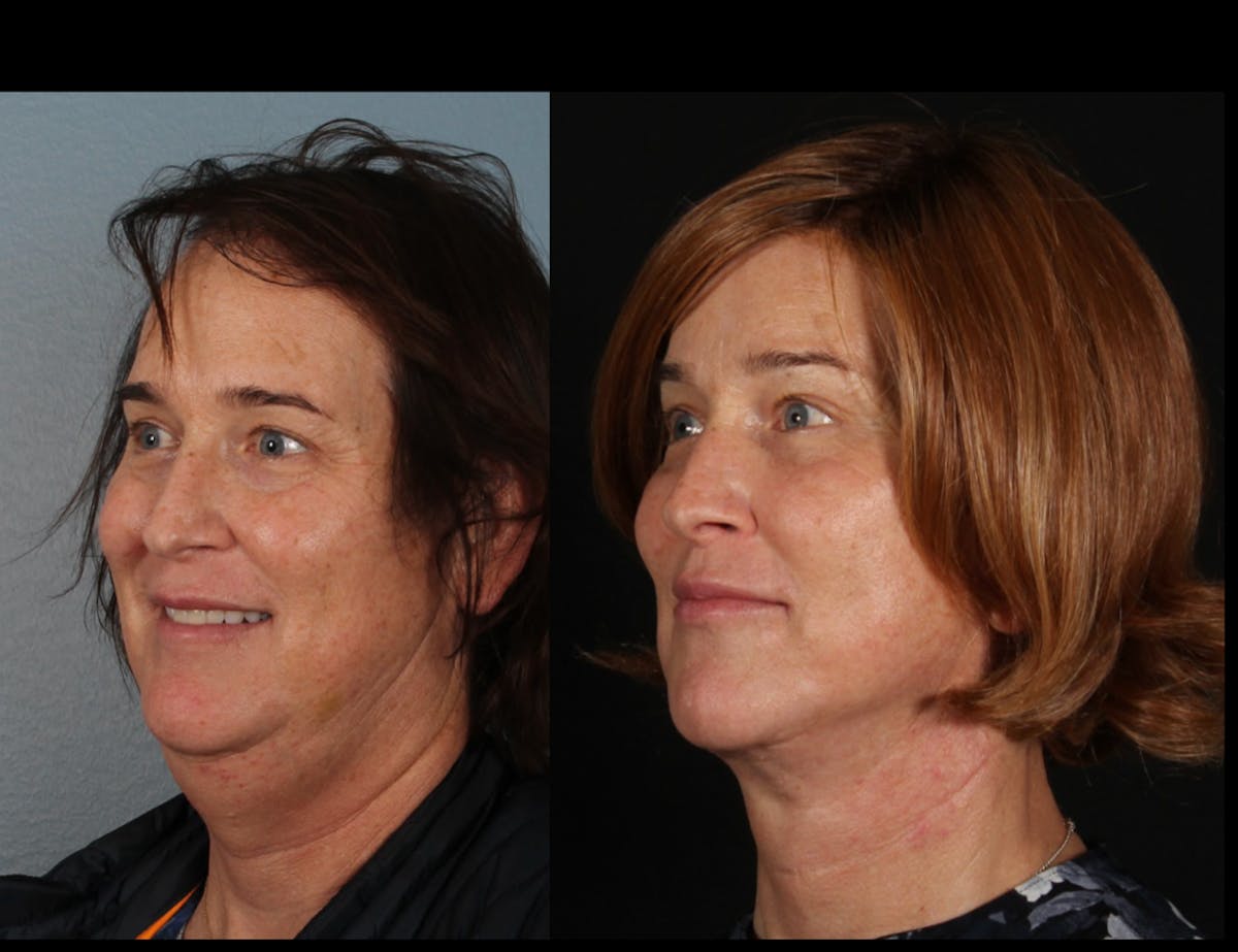 Facial Feminization Surgery (FFS) Before & After Gallery - Patient 298135 - Image 2