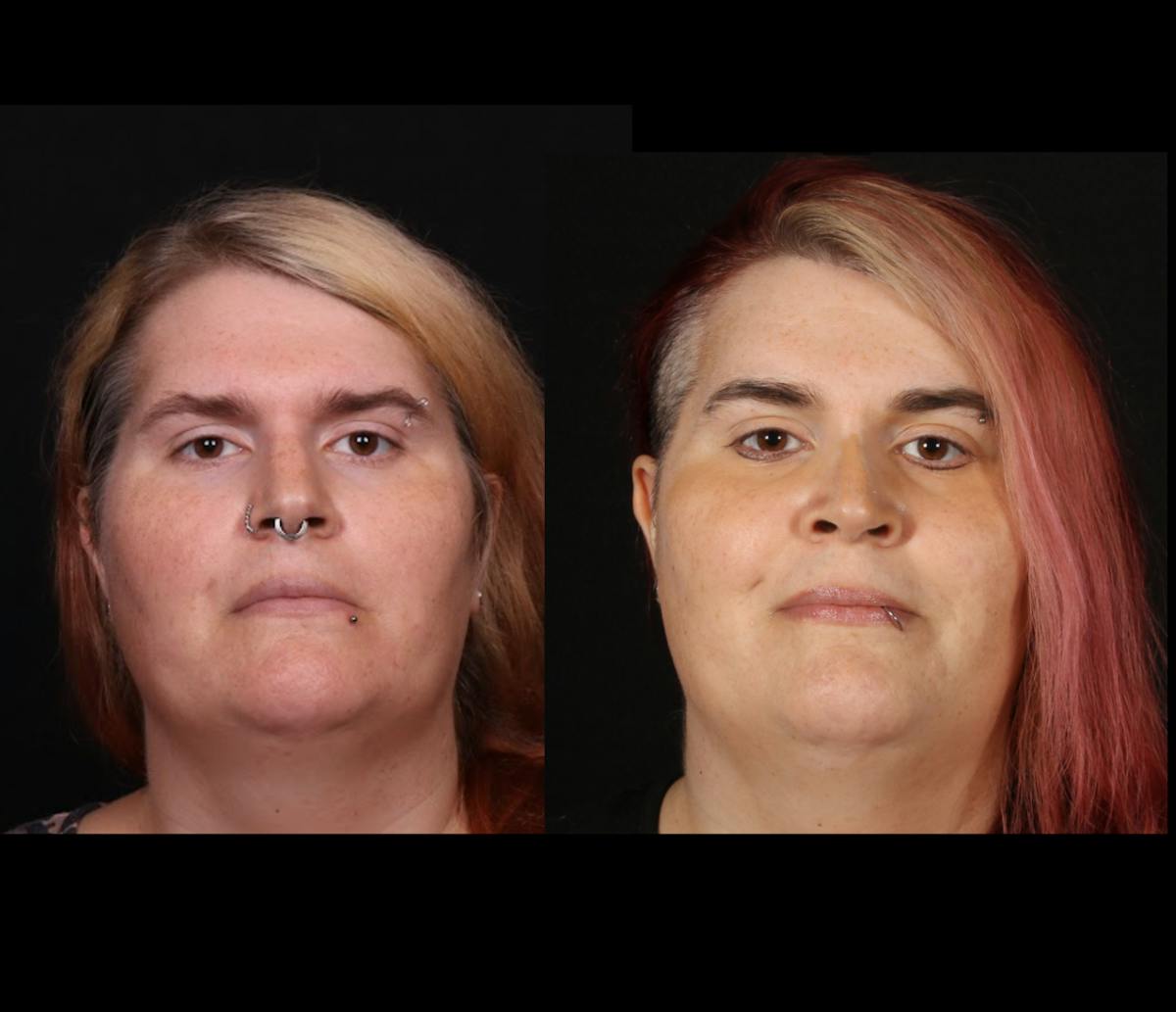 Facial Feminization Surgery (FFS) Before & After Gallery - Patient 348445 - Image 1