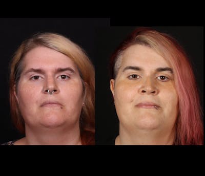 Facial Feminization Surgery (FFS) Before & After Gallery - Patient 348445 - Image 1