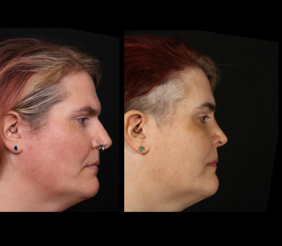 Facial Feminization Surgery (FFS) Before & After Gallery - Patient 348445 - Image 3