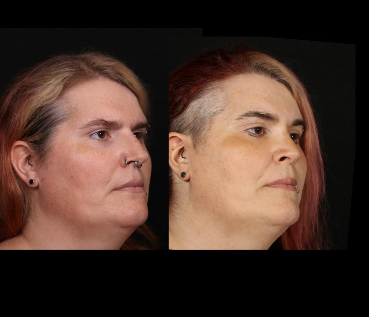 Facial Feminization Surgery (FFS) Before & After Gallery - Patient 348445 - Image 2
