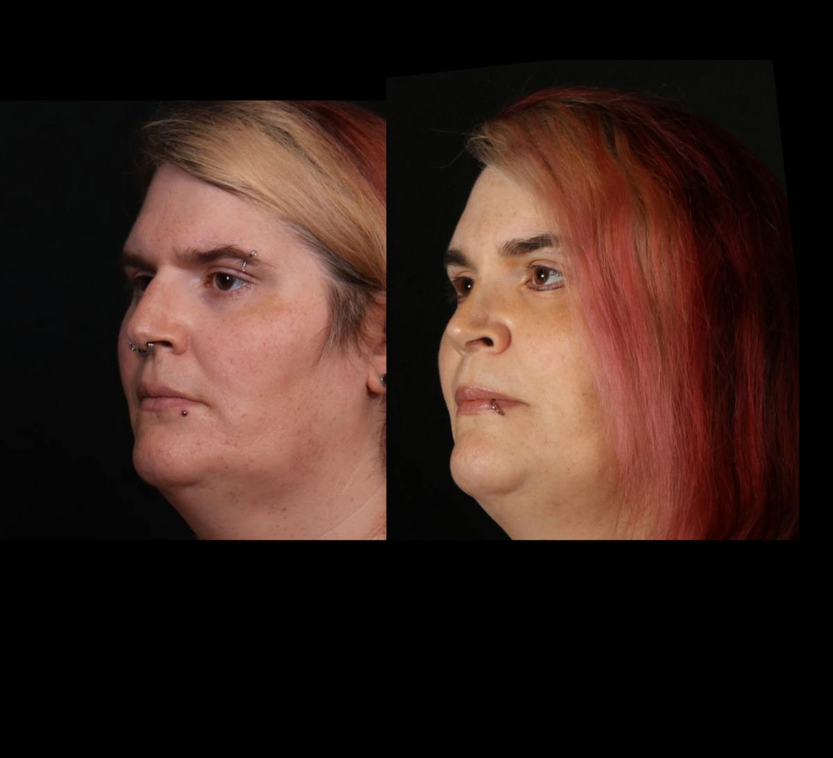 Facial Feminization Surgery (FFS) Before & After Gallery - Patient 348445 - Image 4