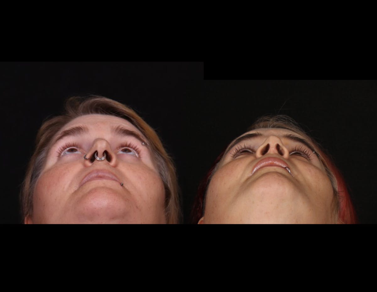 Facial Feminization Surgery (FFS) Before & After Gallery - Patient 348445 - Image 6