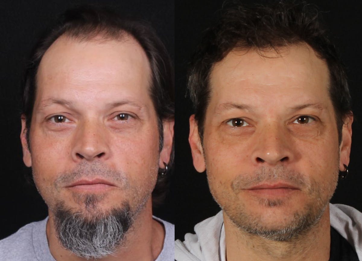 Hair Restoration Before & After Gallery - Patient 252653 - Image 4