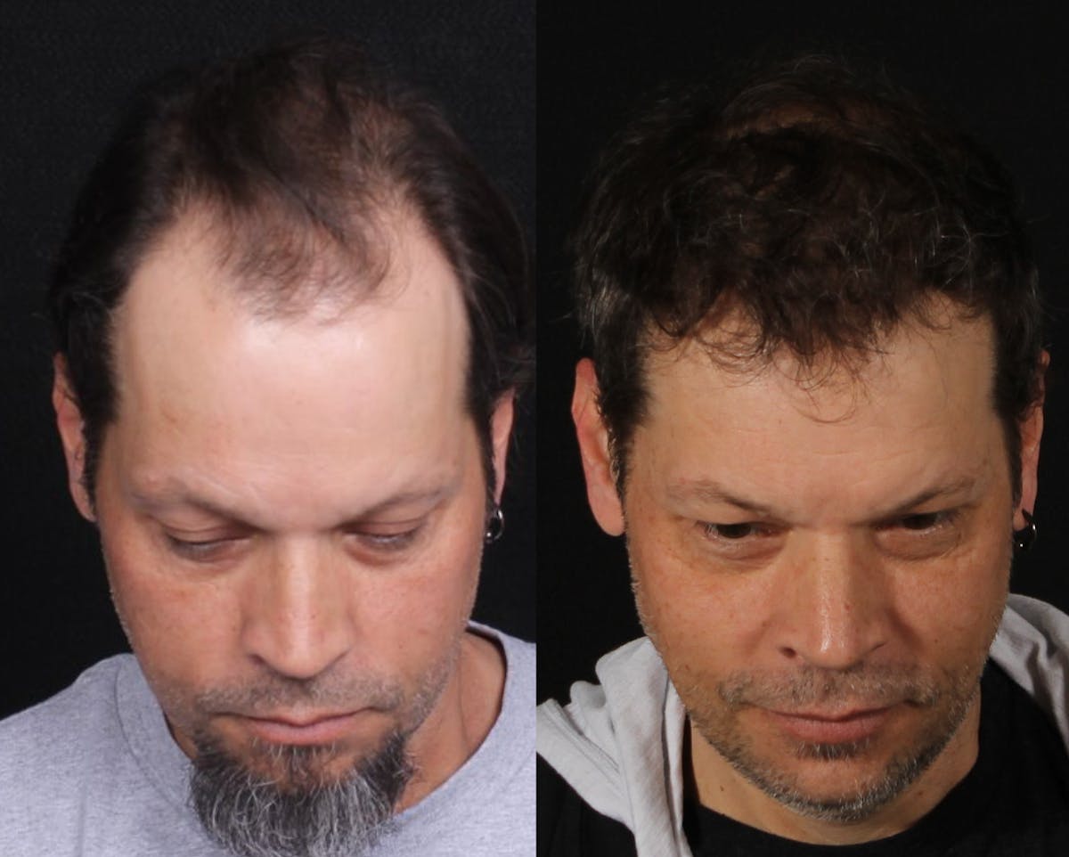 Hair Restoration Before & After Gallery - Patient 252653 - Image 1