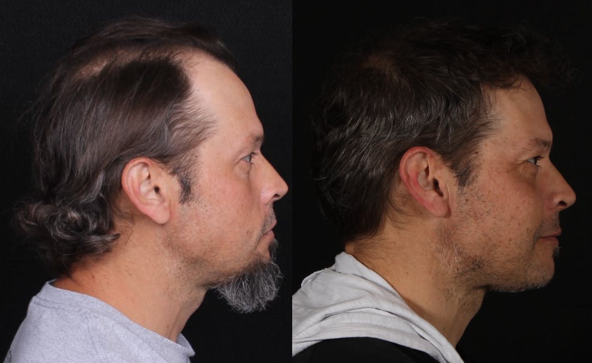 Hair Restoration Before & After Gallery - Patient 252653 - Image 6