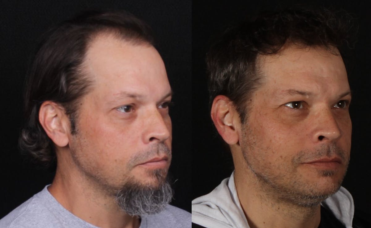 Hair Restoration Before & After Gallery - Patient 252653 - Image 5
