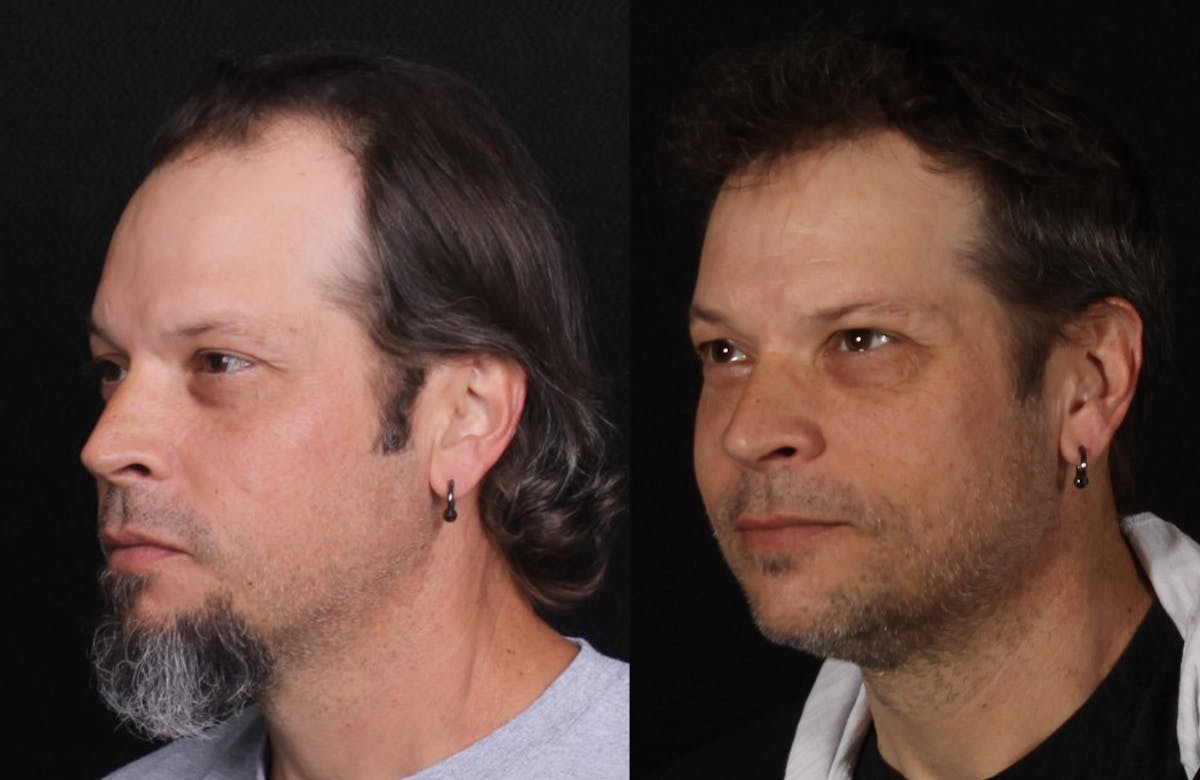 Hair Restoration Before & After Gallery - Patient 252653 - Image 7