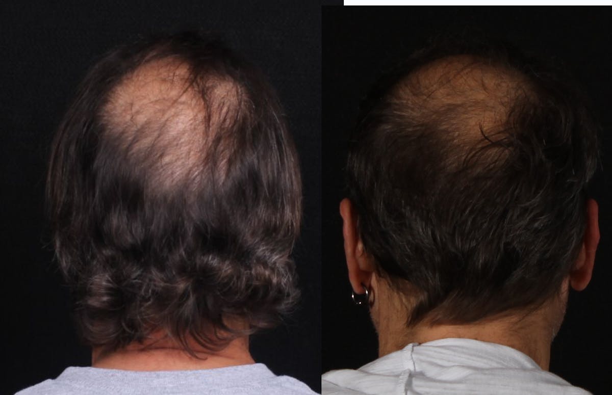 Hair Restoration Before & After Gallery - Patient 252653 - Image 3