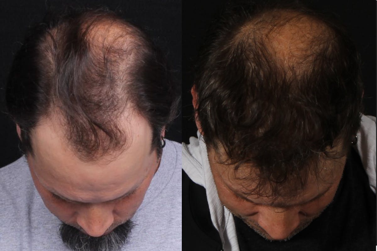 Hair Restoration Before & After Gallery - Patient 252653 - Image 2