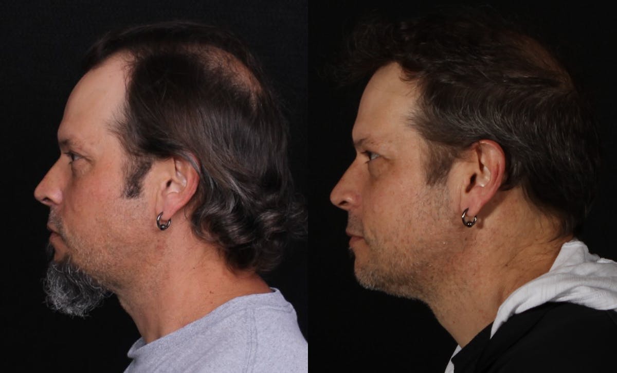 Hair Restoration Before & After Gallery - Patient 252653 - Image 8