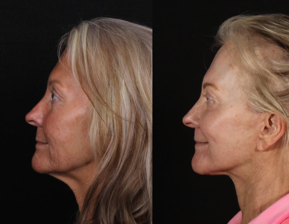 Laser Treatments Before & After Gallery - Patient 323980 - Image 3