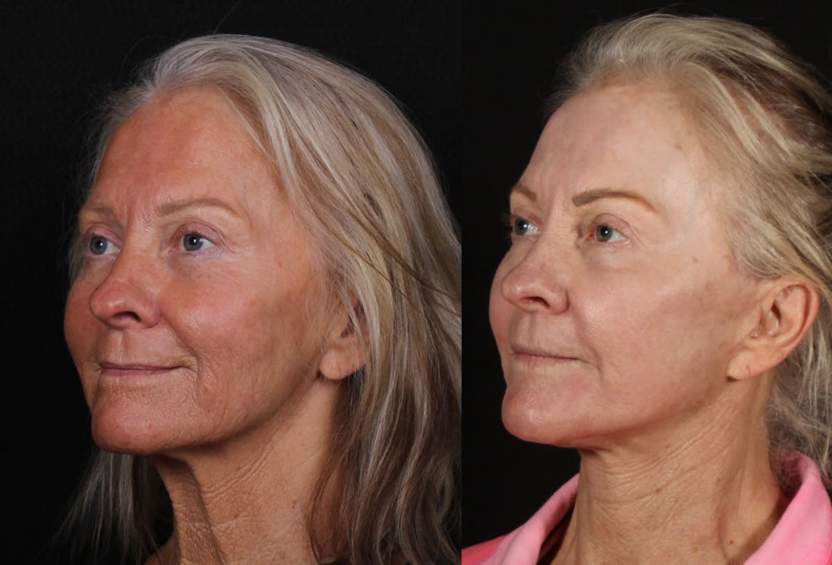 Laser Treatments Before & After Gallery - Patient 323980 - Image 2