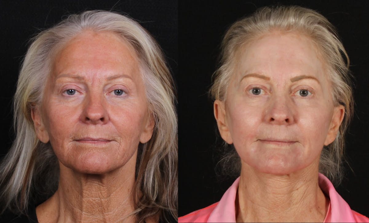 Laser Treatments Before & After Gallery - Patient 323980 - Image 1