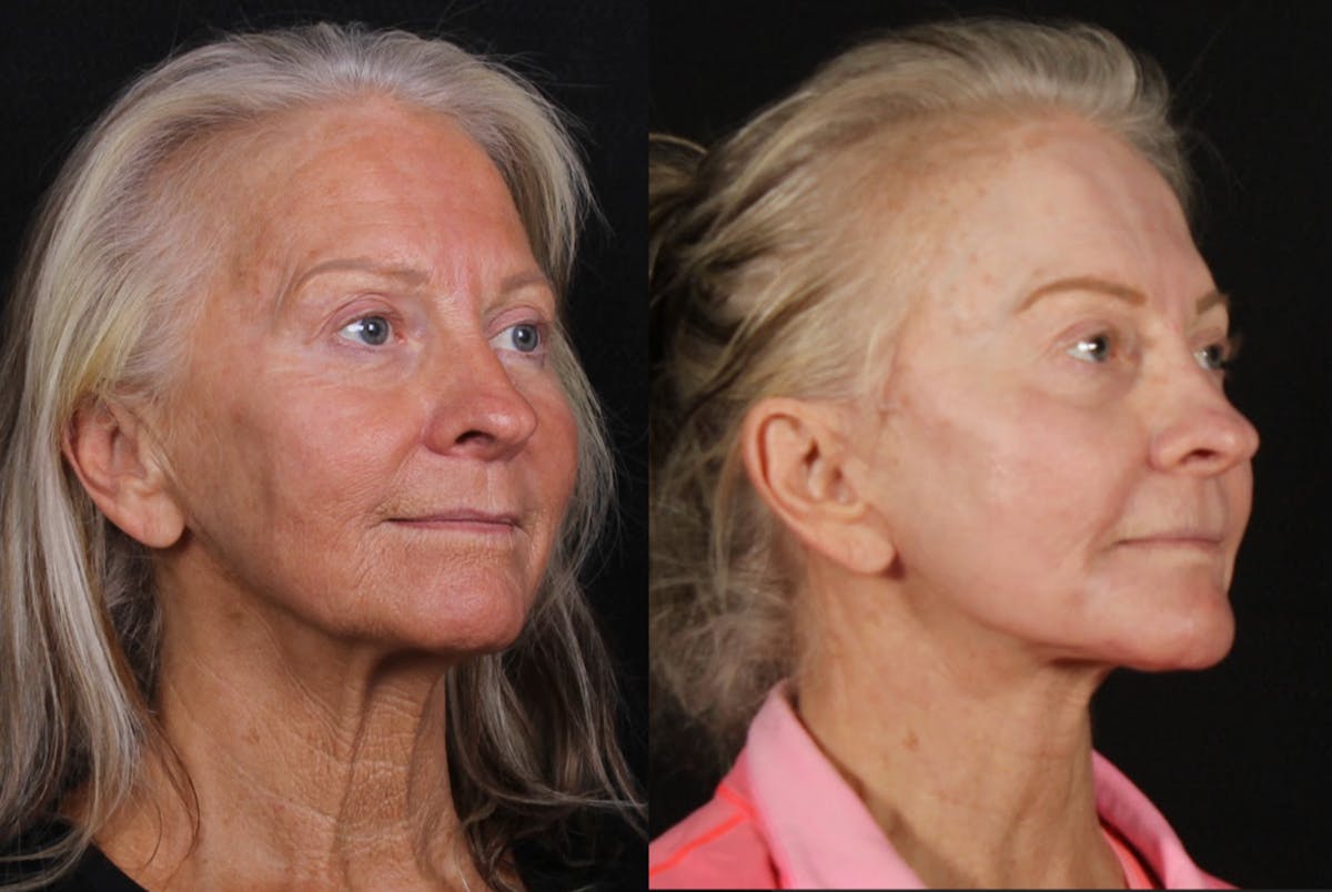 Laser Treatments Before & After Gallery - Patient 323980 - Image 4