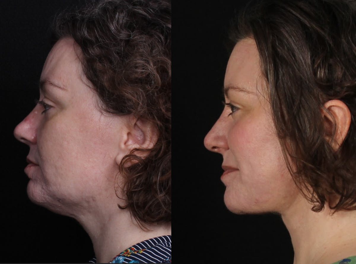 Laser Treatments Before & After Gallery - Patient 351449 - Image 5