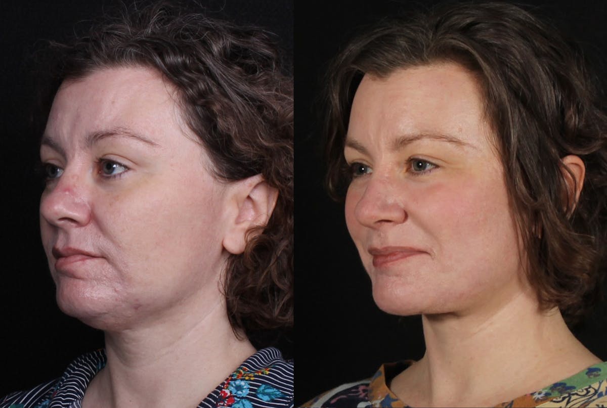 Laser Treatments Before & After Gallery - Patient 351449 - Image 4
