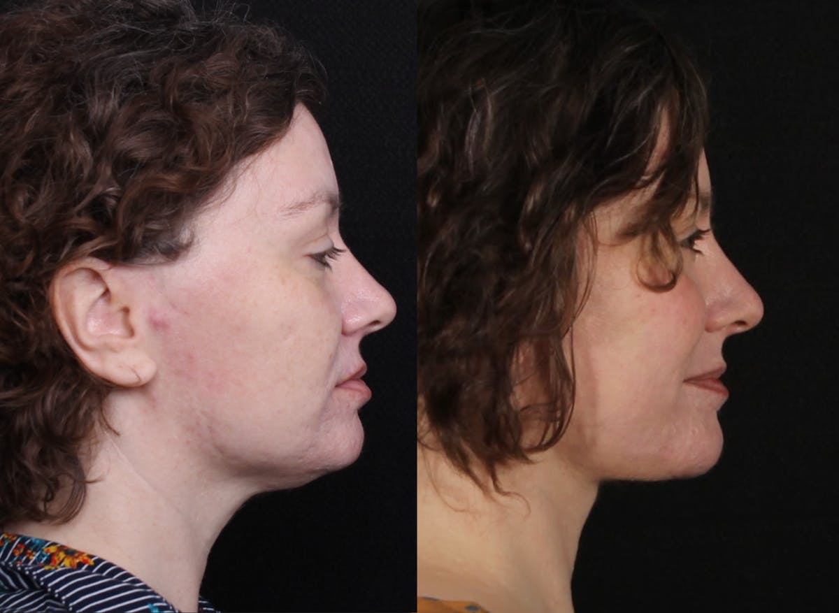 Laser Treatments Before & After Gallery - Patient 351449 - Image 3