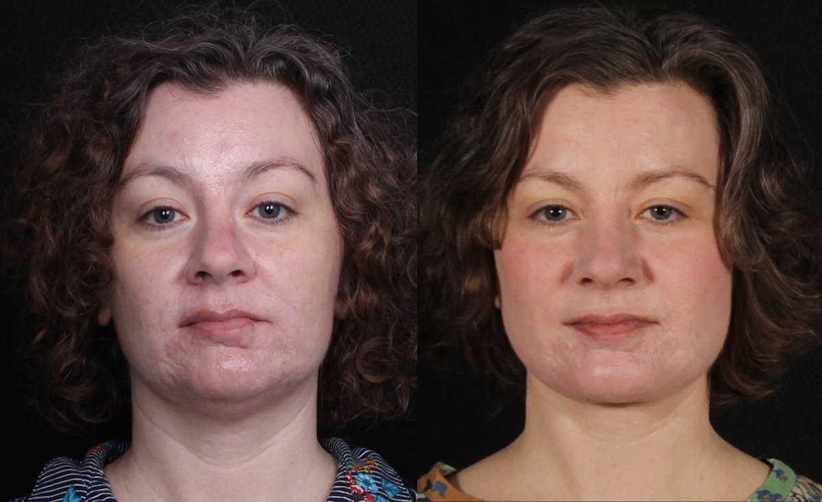 Laser Treatments Before & After Gallery - Patient 351449 - Image 1