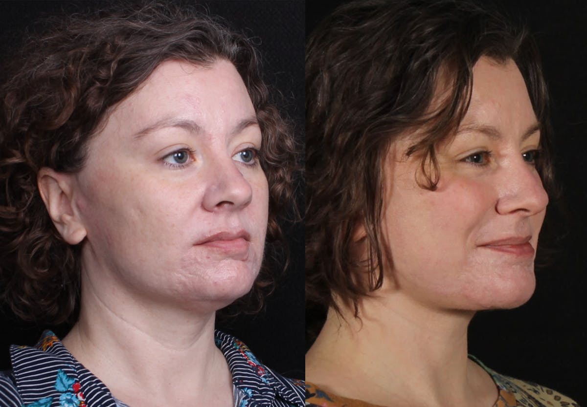 Laser Treatments Before & After Gallery - Patient 351449 - Image 2