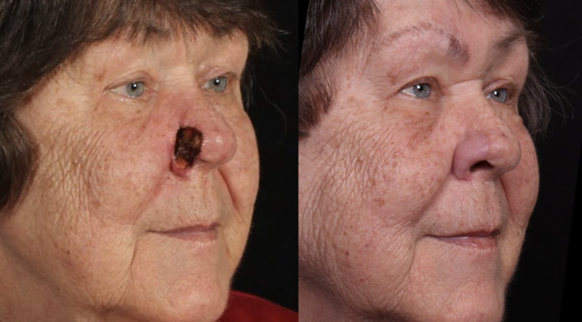 Mohs Surgery Before & After Gallery - Patient 374308 - Image 2