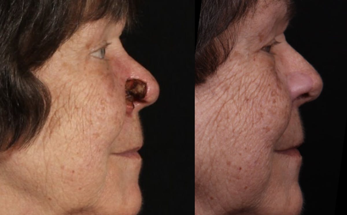 Mohs Surgery Before & After Gallery - Patient 374308 - Image 3