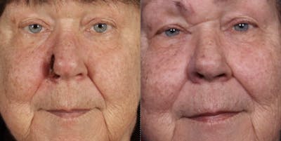 Mohs Surgery Before & After Gallery - Patient 374308 - Image 1