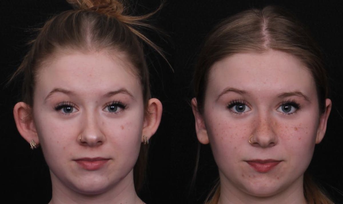 Otoplasty Before & After Gallery - Patient 305721 - Image 1