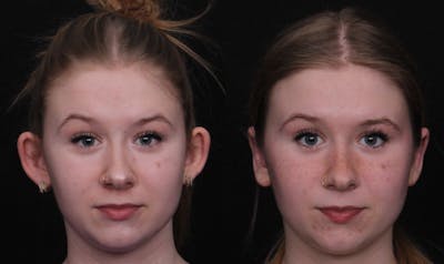 Otoplasty Before & After Gallery - Patient 305721 - Image 1