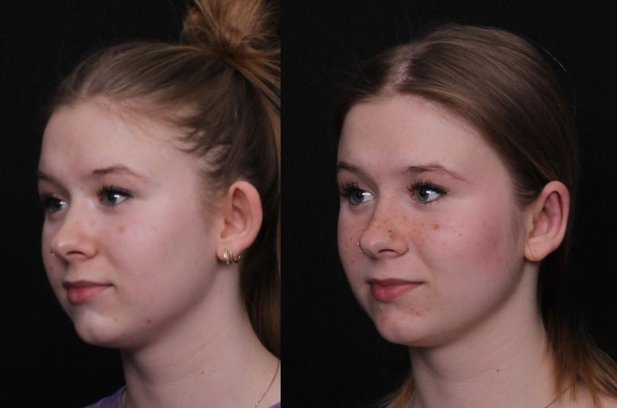 Otoplasty Before & After Gallery - Patient 305721 - Image 4