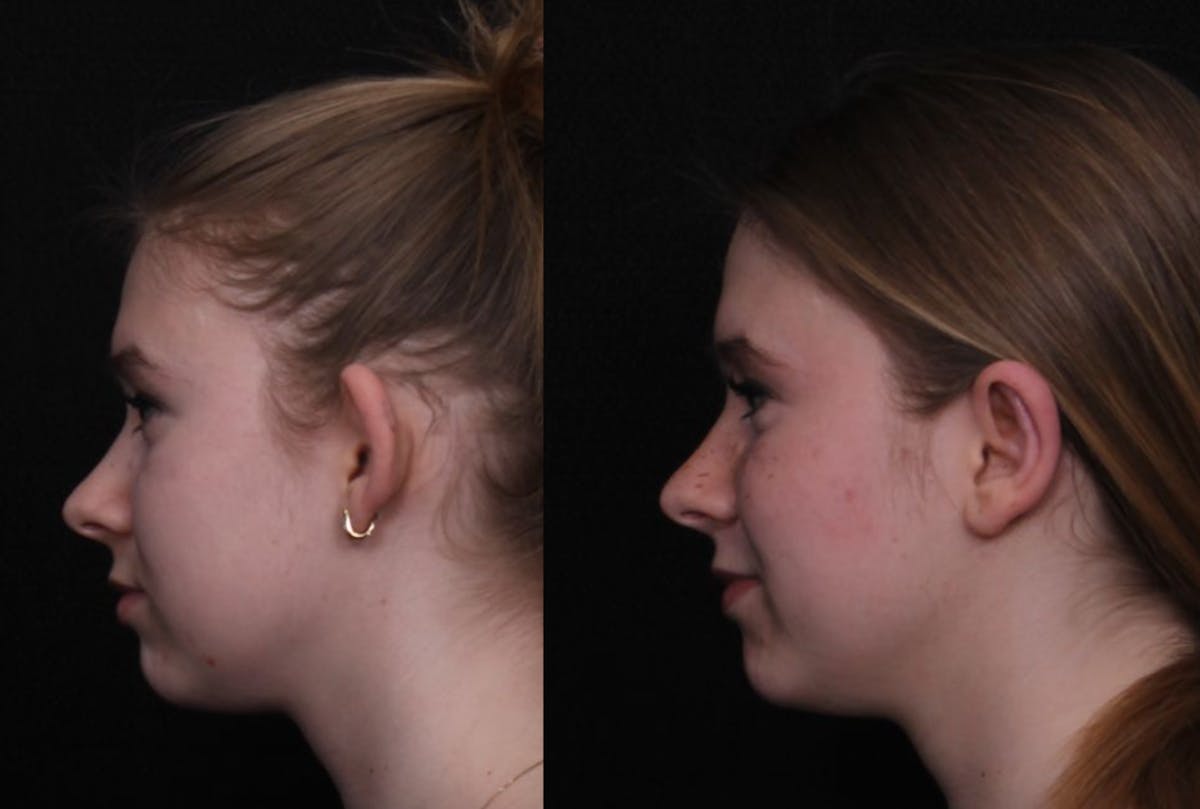 Otoplasty Before & After Gallery - Patient 305721 - Image 5