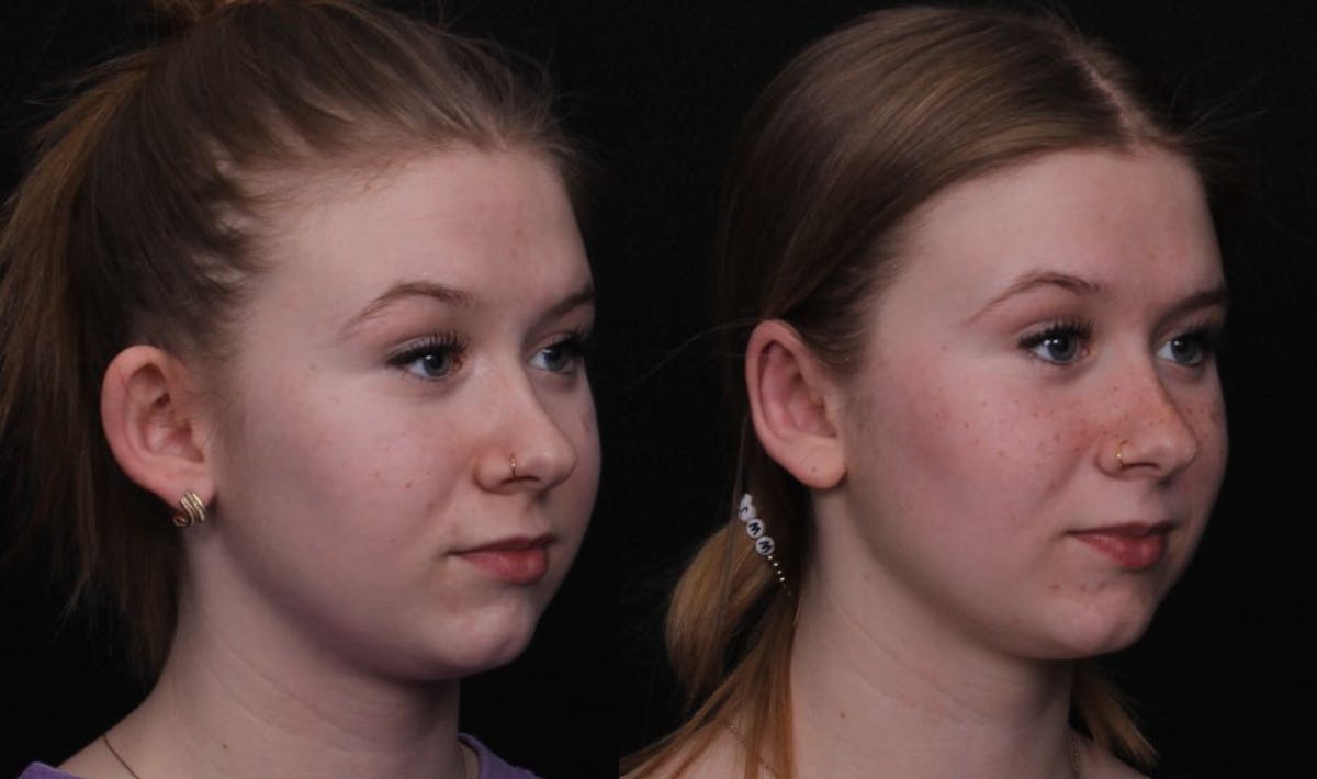 Otoplasty Before & After Gallery - Patient 305721 - Image 2