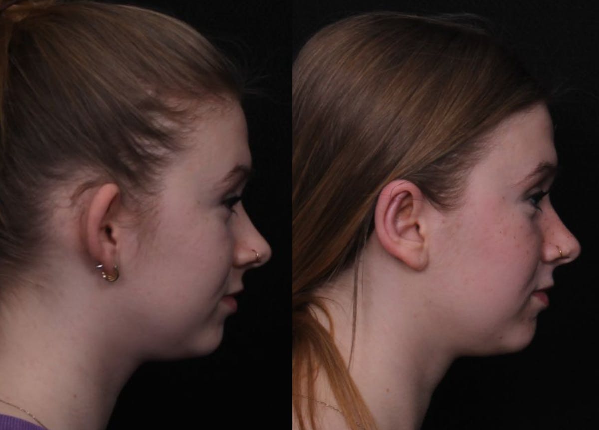 Otoplasty Before & After Gallery - Patient 305721 - Image 3