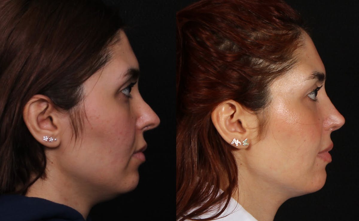 Rhinoplasty Female Before & After Gallery - Patient 422450 - Image 1