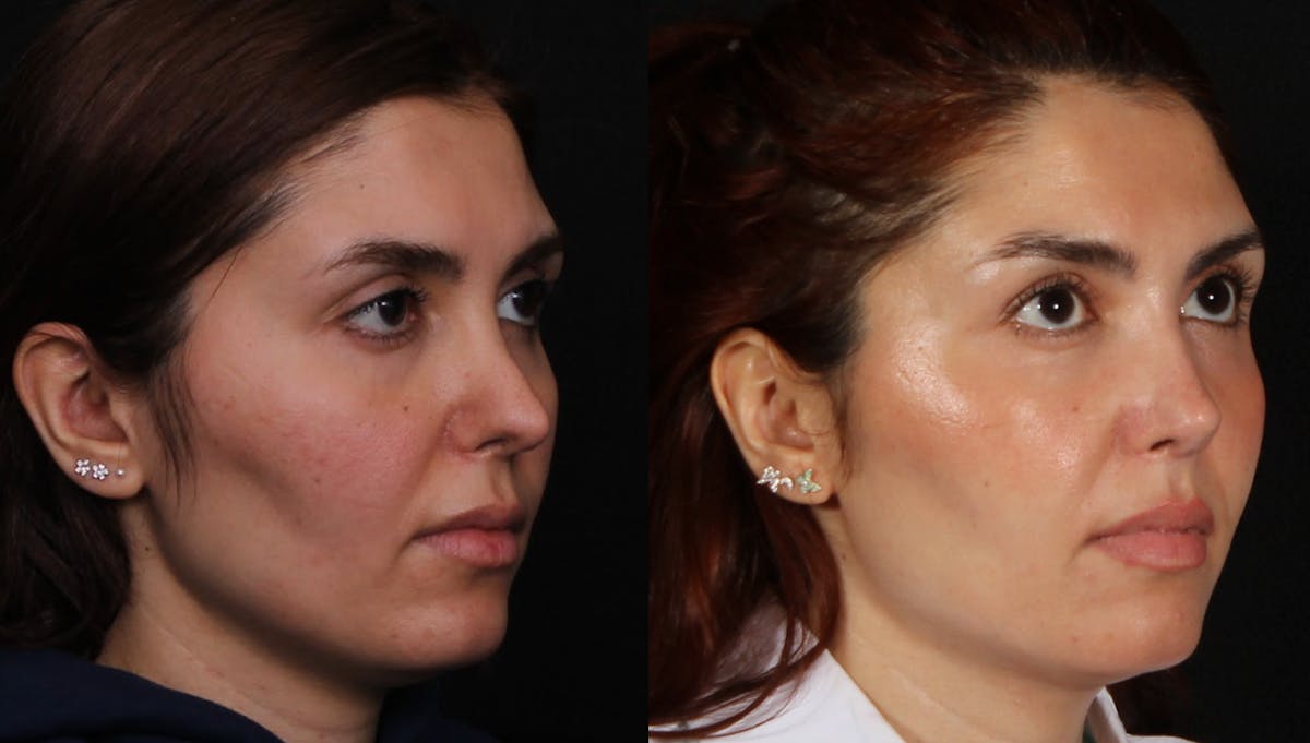 Rhinoplasty Female Before & After Gallery - Patient 422450 - Image 2