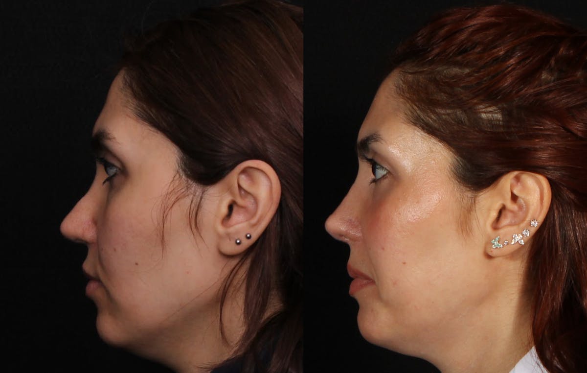 Rhinoplasty Female Before & After Gallery - Patient 422450 - Image 5