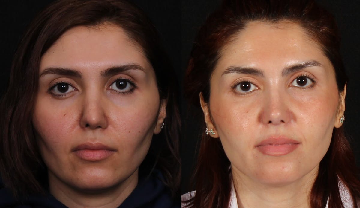 Rhinoplasty Female Before & After Gallery - Patient 422450 - Image 3
