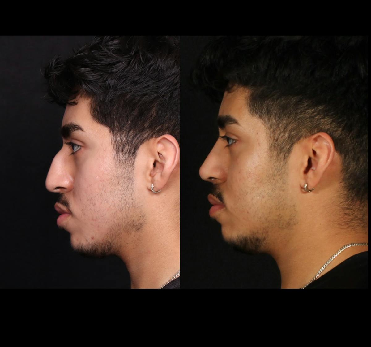 Rhinoplasty Male Before & After Gallery - Patient 584341 - Image 6
