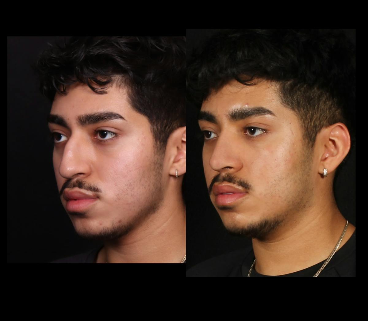 Rhinoplasty Male Before & After Gallery - Patient 584341 - Image 5