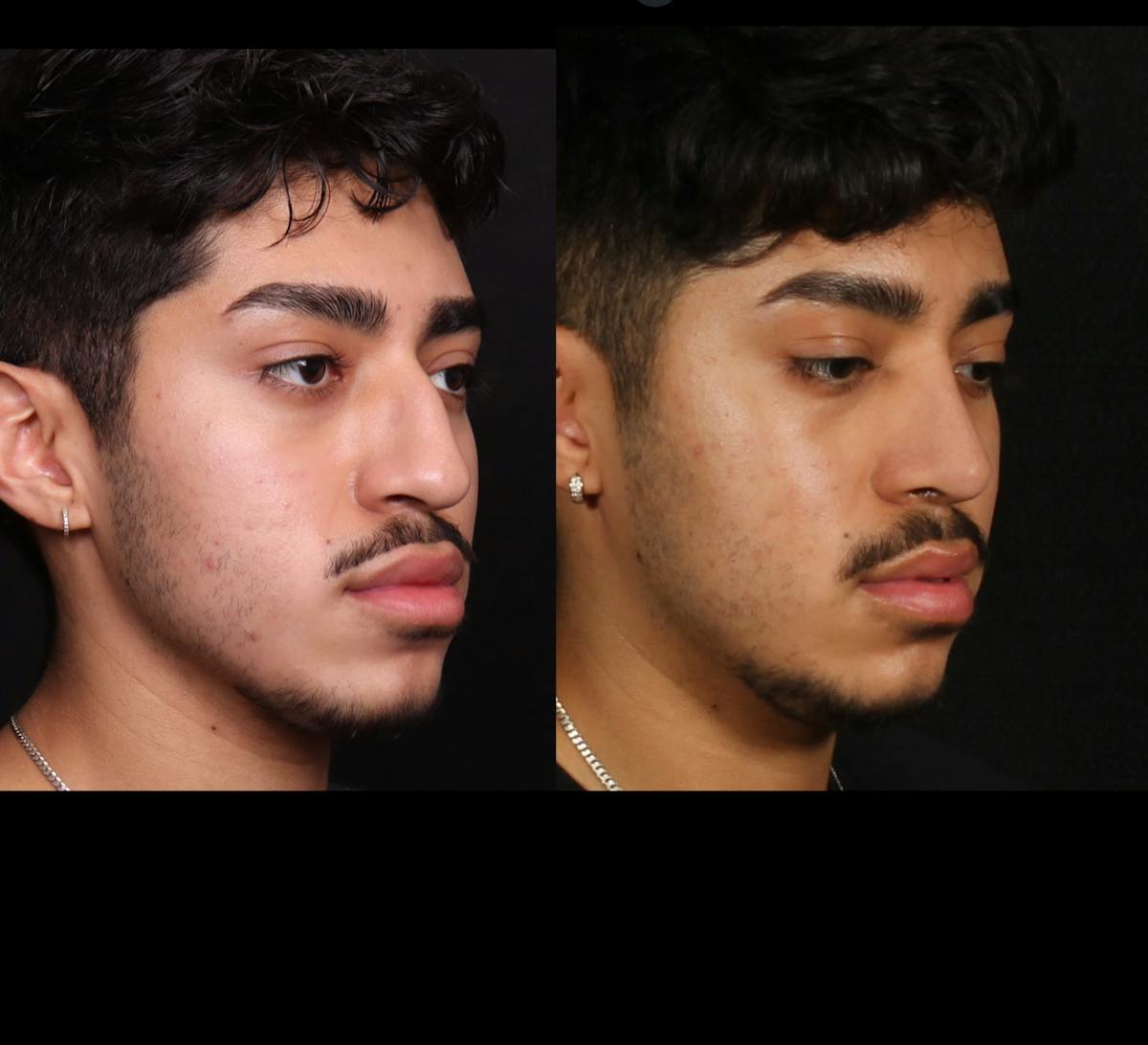 Rhinoplasty Male Before & After Gallery - Patient 584341 - Image 2