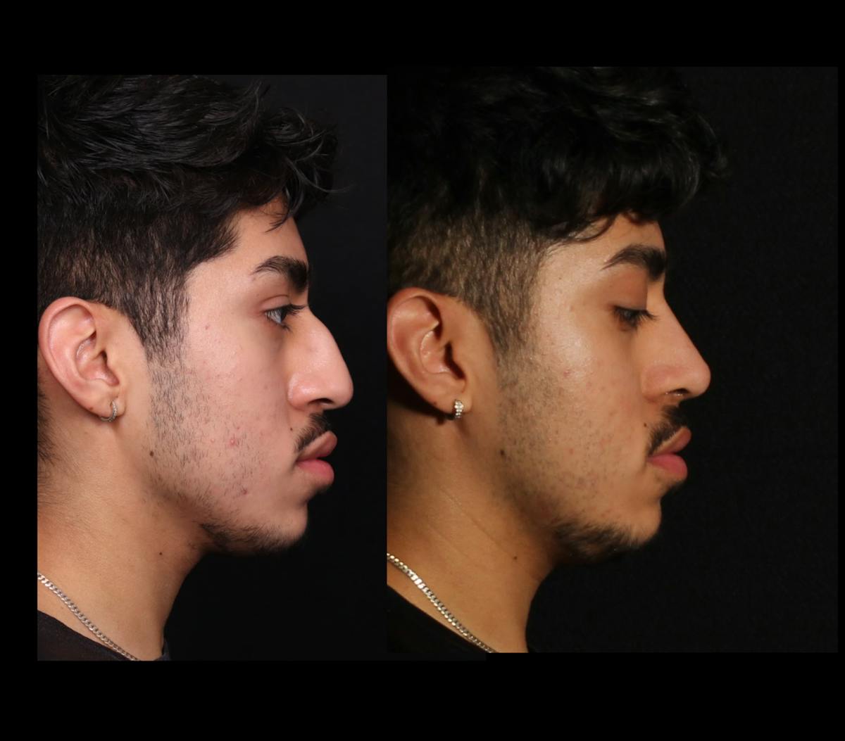 Rhinoplasty Male Before & After Gallery - Patient 584341 - Image 1